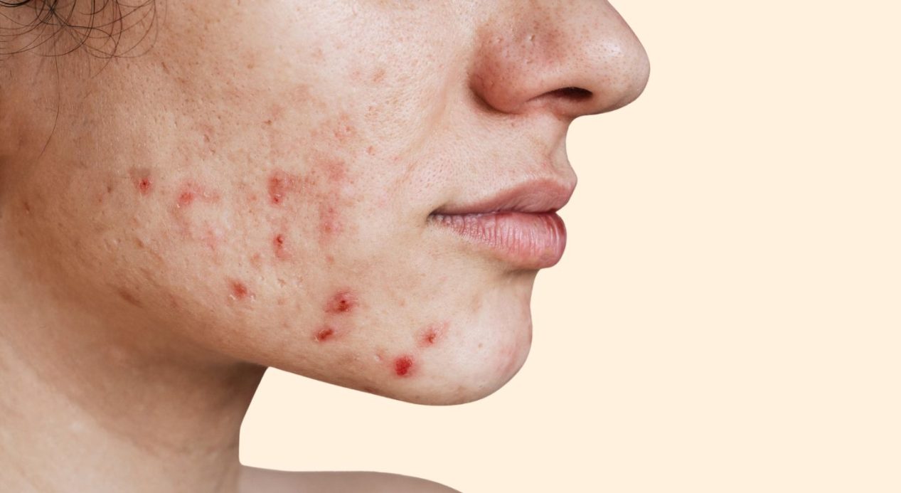 acne-face-map-alt-1440x810
